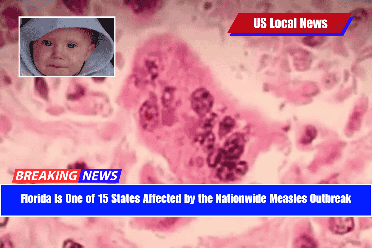 Florida Is One of 15 States Affected by the Nationwide Measles Outbreak